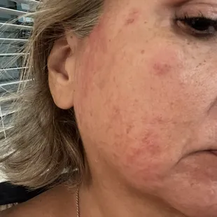 Facial wax results at Lena's from Julie. I got some burns and a rash.  This was my first experience at Lena's.