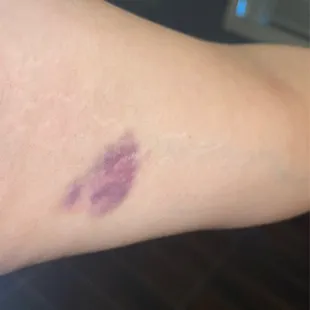 a red spot on the arm of a woman