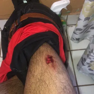 a man with a wound on his leg