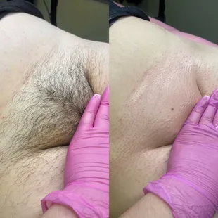 Brazilian wax