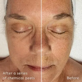 Amazing before and after of a client who has done a series of chemical peels