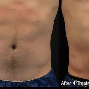 AccuFit Muscle Sculpting