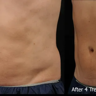 AccuFit Muscle Sculpting