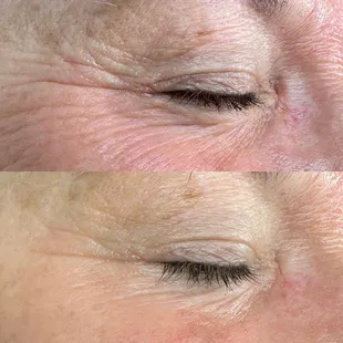 After three AdvaTx treatments.