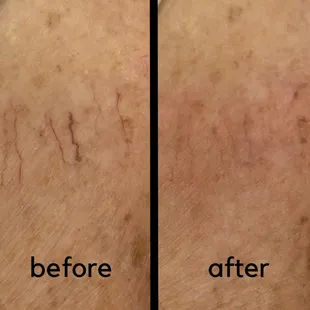 Spider Vein Reduction