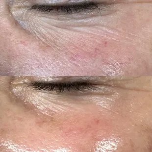 After three AdvaTx treatments.