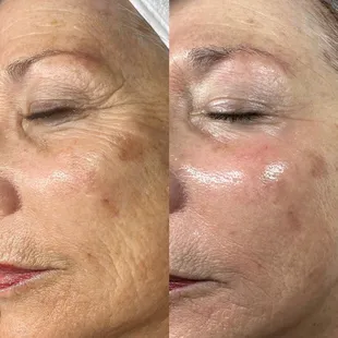 After three AdvaTx treatments.