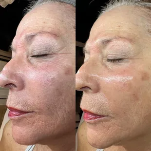 After three AdvaTx treatments.