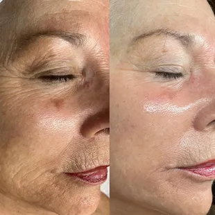 After three AdvaTx treatments.