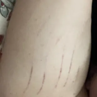 My right inner arm after my surgery at Lovelace Women&apos;s Hospital in Albuquerque, NM.  The blood pressure cuff squeezed my arm.