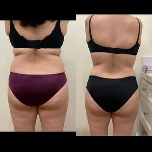 Body sculpting after 4 session