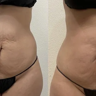 Skin tightening sessions