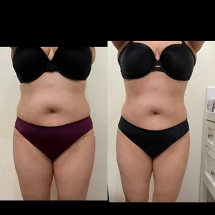 Body sculpting after 4 session