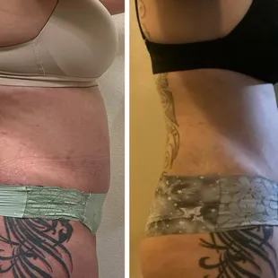 Body sculpting treatment after ONE session