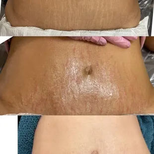 Stretch mark camouflage rejuvenation