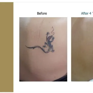 Tattoo removal