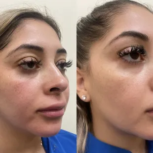 Microneedling with radio frequency and laser MD session using virture RF device
