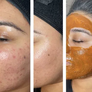 Brightening chemical peel 30 day regimen