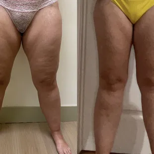 Cellulite treatment FOUR sessions!