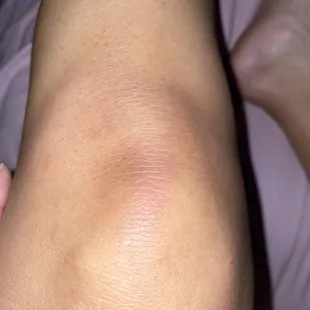 Bruises on my left knee