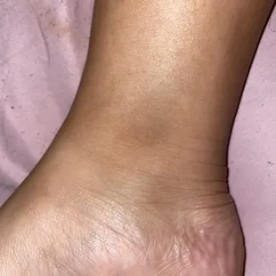 Bruise on my right ankle/foot