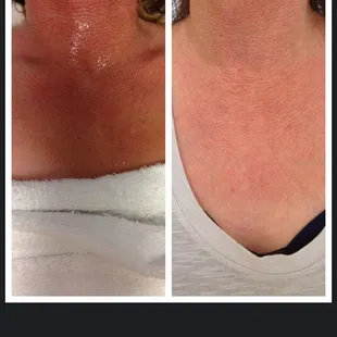 Manasra client before and after IPL  Photofacial of the Décolleté area