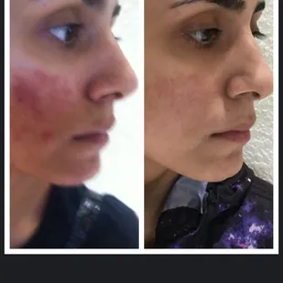 Manasra client before and after Acne treatment