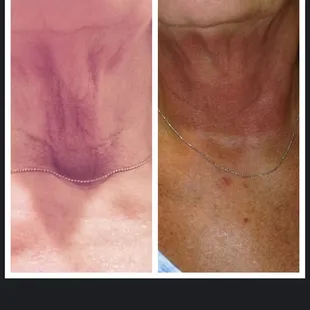 Manasra client before and after Viora Neck and Submental skin tightening