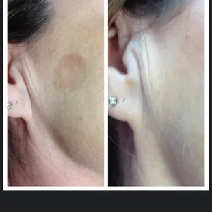 Manasra client before and after IPL Brown Lesion treatment