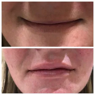 Juvederm lips in 10 minutes! Thank you Doc!