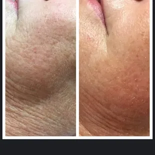 Manasra Client Before and After A Chemical Peel