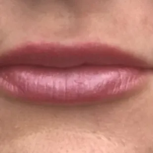 Manasra patient- Juvederm lips