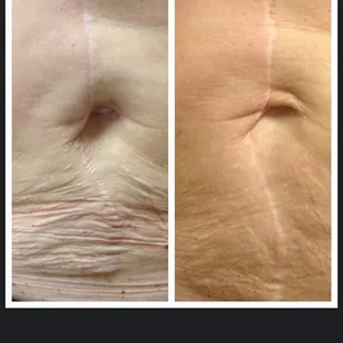 Manasra client before and after Viora Skin tightening