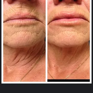 Manasra client before and after Upper and Lower Lip Augmentation with Juvederm