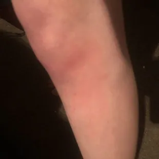 Allergic reaction to bites
