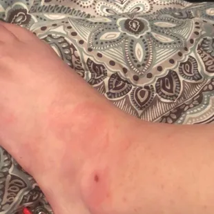 Bites and allegeric reaction