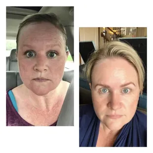 Only after 1 treatment! Hydrafacial Oxygen combo facial. Brow shaping with brow tint.