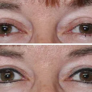 Before &amp; after healed eyeliner