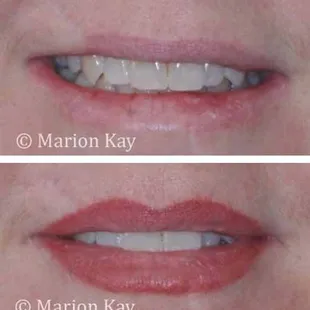 Before &amp; healed lip blend