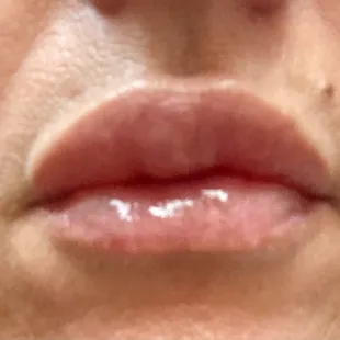 20 Days after bad filler technique