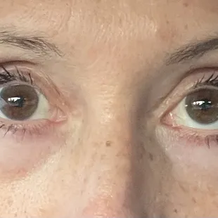 I look worse than before surgery and he pretends he doesn't see the difference between the eyes. I do not recommend going to this surgeon.