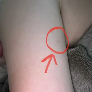 The red dot is where I felt the guy stab me with a needle &amp; instantly felt tingly and numb!