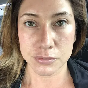 First hydro facial and dermal plane. Fantastic!