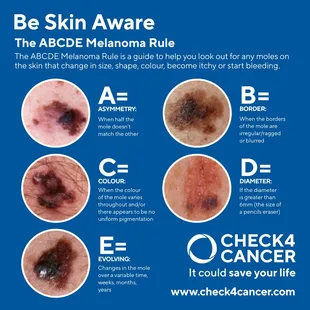 ABCDE Melanoma Rule