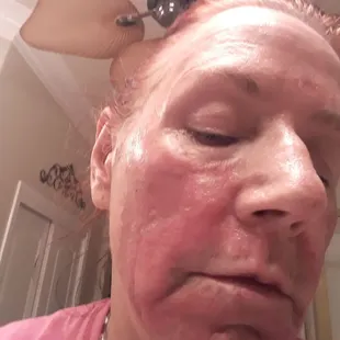 After peel recommended by nurse 8 days before my daughter's wedding.