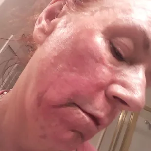 Told by nurse my face would look like a baby's butt not a baboons butt!