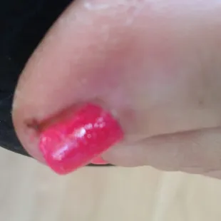 My toe damage