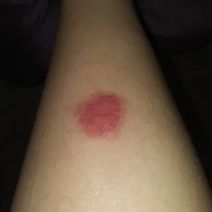 My infected spider bite that i got from this park while going through the unkept museum.