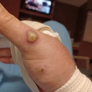 Hospitalized ! Staff.