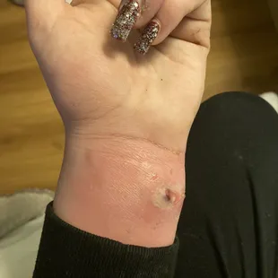 Staff infection. Given by motel six!